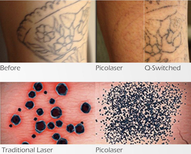 2018 Latest Picosure Laser Tattoo Removal Pico Second Laser Machine