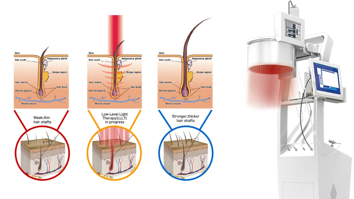 Diode Laser Hair Regrowth Machine Diode Laser Hair Regrowth Machine